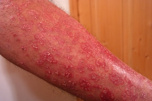 Ayurvedic Treatment and Home Remedies for Psoriasis