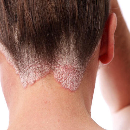 Psoriasis and its Causes According to Ayurveda